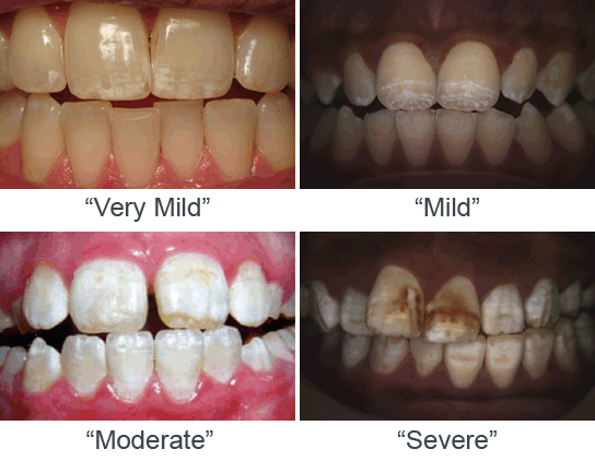 Dental Fluorosis